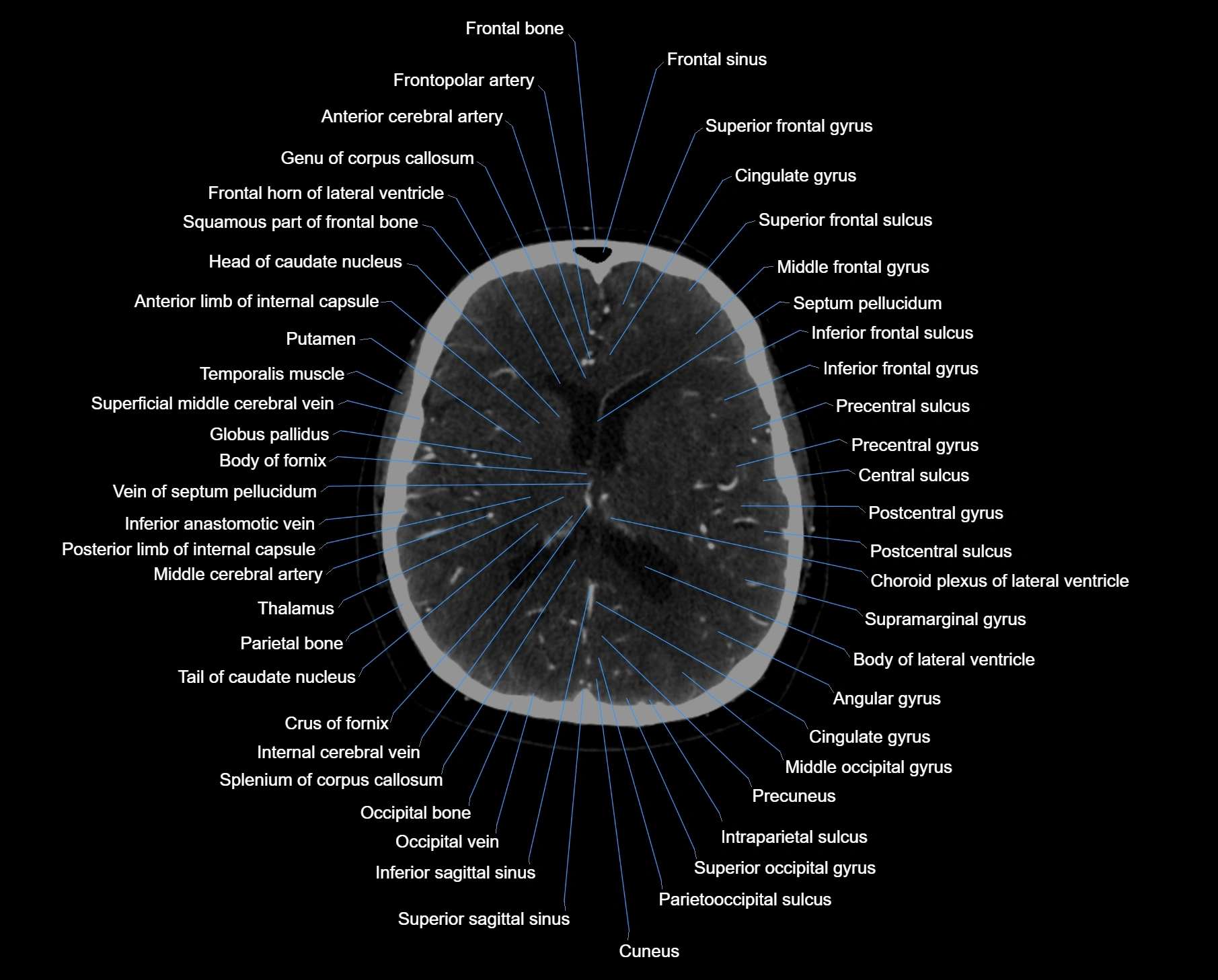 CT scan brain axial labelled cross sectional anatomy image-img-000040.webp